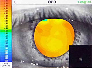 視力検査【視力1.0の見え方の質が見える】角膜形状/屈折力解析装置　OPD-Scan lll VS