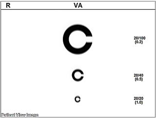 視力検査【視力1.0の見え方の質が見える】角膜形状/屈折力解析装置　OPD-Scan lll VS